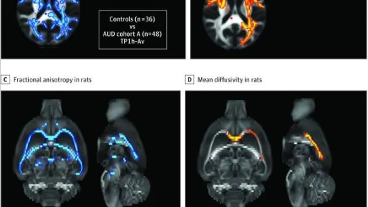 Estructura del cerebro en la adicci&oacute;n.