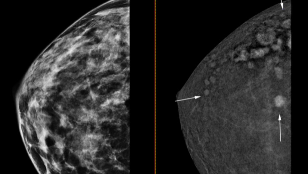 Mamografía en 3D con contraste.