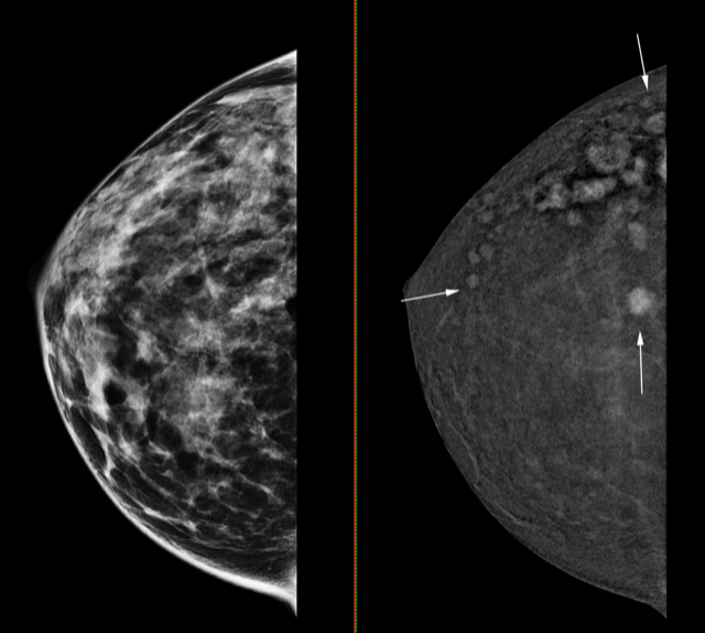 El Hospital Universitario del Vinalopó incorpora un mamógrafo 3D con contraste capaz de detectar tumores de solo cuatro milímetros El Hospital Universitario del Vinalopó incorpora un mamógrafo 3D con contraste capaz de detectar tumores de solo cuatro milímetros