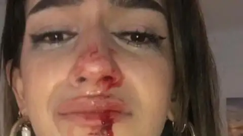 Propinan una brutal paliza a una joven transexual en Barcelona: "No más transfobia, no quiero morir mañana"