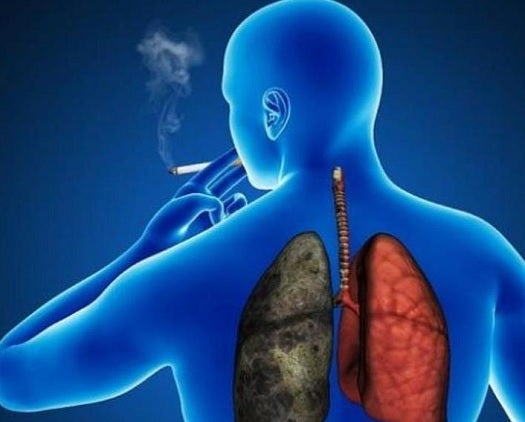 Cáncer de pulmón: solo un 30% de los tumores se diagnostican cuando todavía son curables Cáncer de pulmón: solo un 30% de los tumores se diagnostican cuando todavía son curables