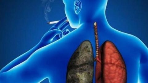 C&aacute;ncer de pulm&oacute;n