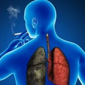 Cáncer de pulmón Cáncer de pulmón