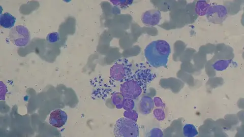 Frotis de médula ósea Frotis de médula ósea