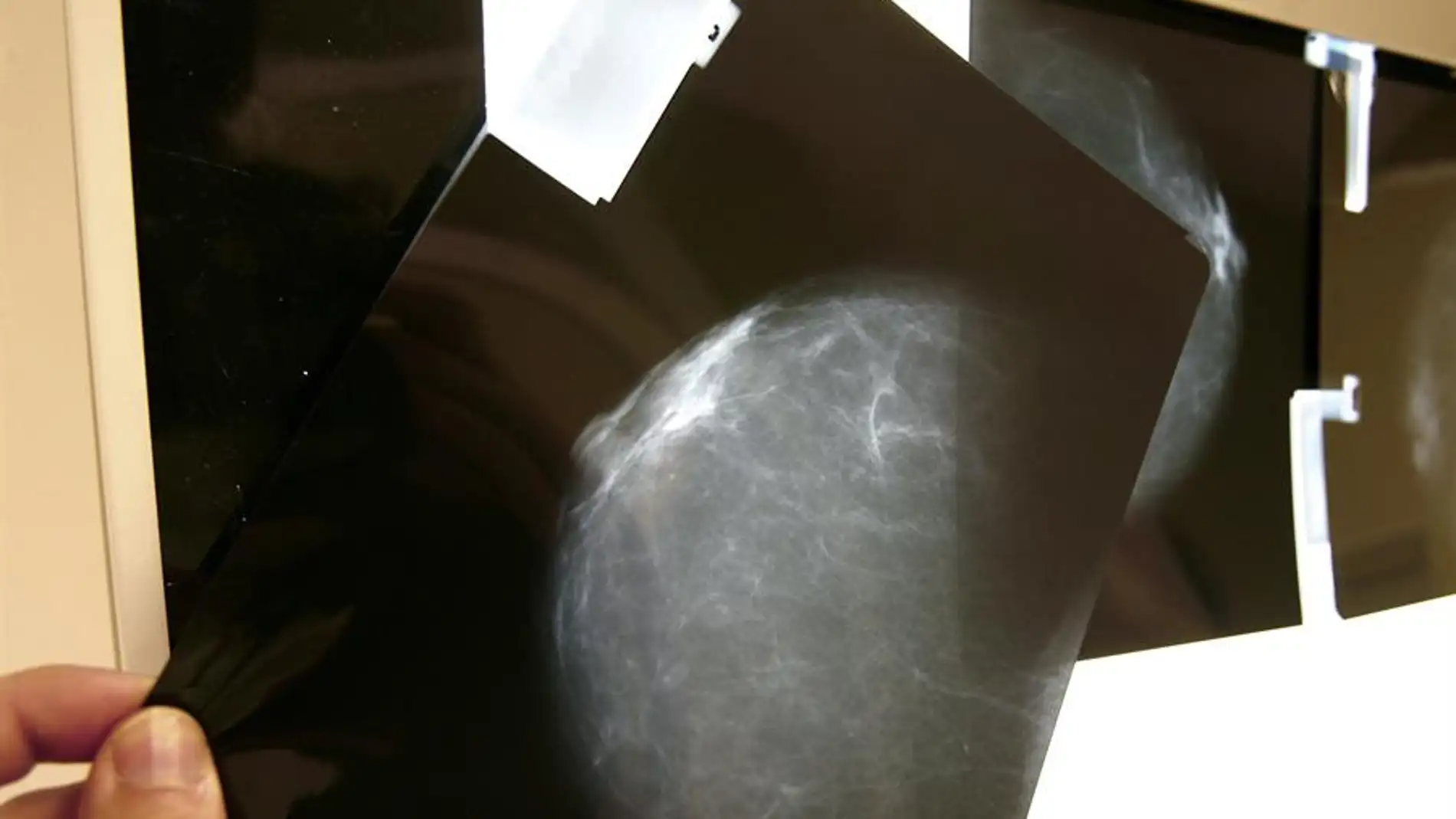 Sanidad indemnizará con 30.000 euros a una mujer por el retraso de cinco meses en el diagnóstico de un cáncer de mama