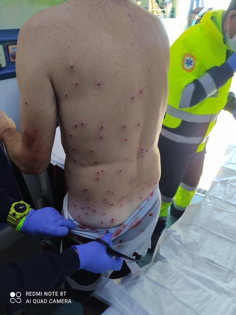 Un ciclista recibe más de cien perdigones de un cazador que lo confundió con un conejo Un ciclista recibe más de cien perdigones de un cazador que lo confundió con un conejo