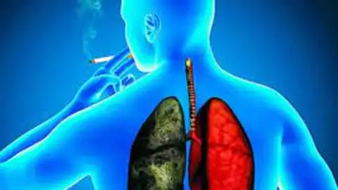 Cáncer de Pulmón Cáncer de Pulmón