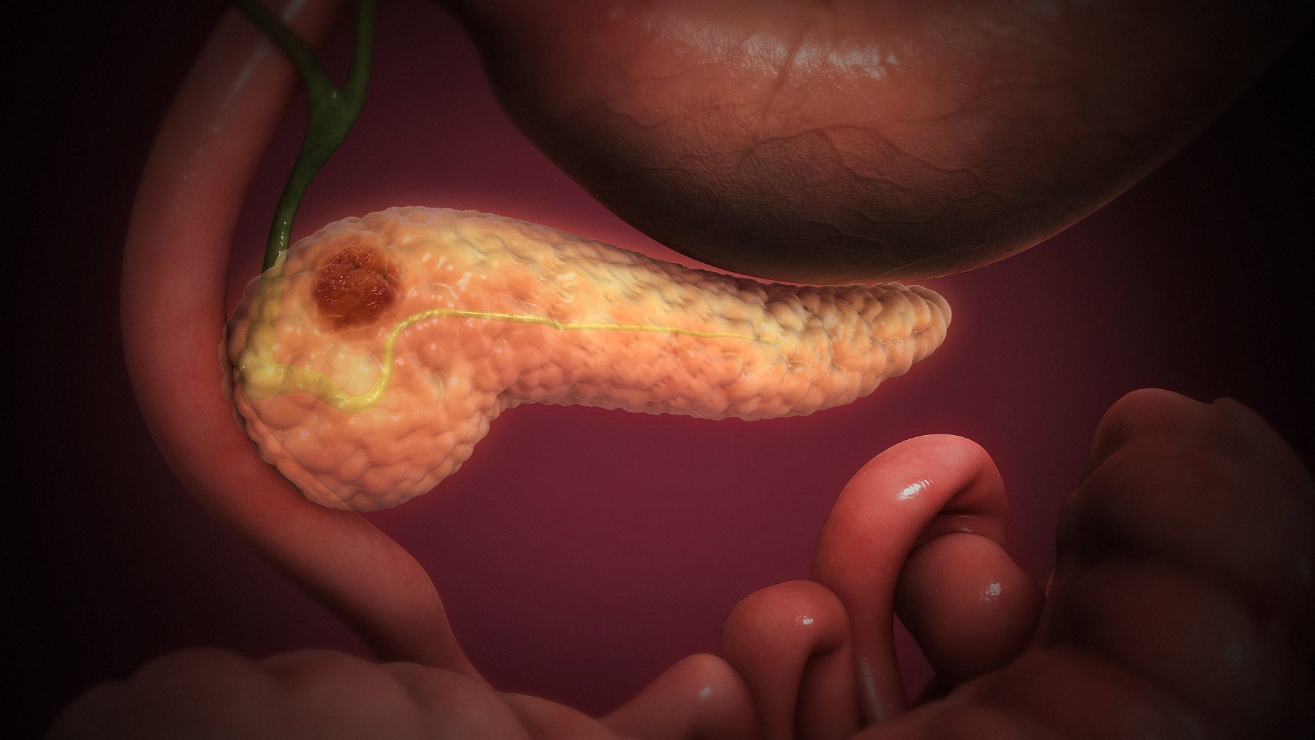 Sube la vulnerabilidad socioeconómica de las personas con cáncer que asumen gastos extra de hasta 300 euros Sube la vulnerabilidad socioeconómica de las personas con cáncer que asumen gastos extra de hasta 300 euros
