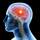 Ilustración de un tumor cerebral