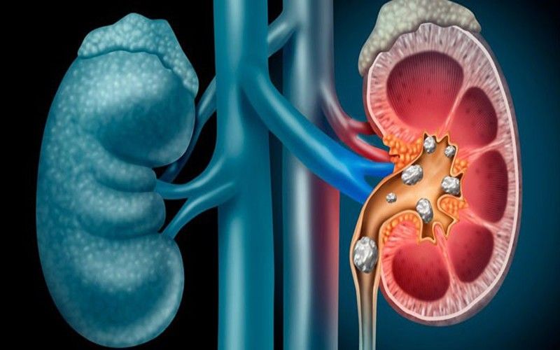Hablamos de la Litiasis con el Dr. Sven Petry, jefe de Urología del Hospital Quironsalud Torrevieja Hablamos de la Litiasis con el Dr. Sven Petry, jefe de Urología del Hospital Quironsalud Torrevieja