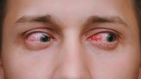 glaucoma