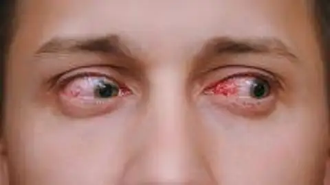 glaucoma glaucoma