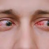 glaucoma glaucoma