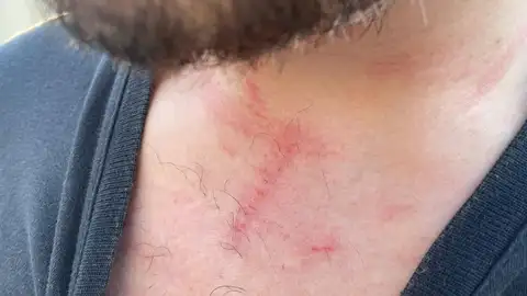 El aficionado mostrando las lesiones Onda Cero