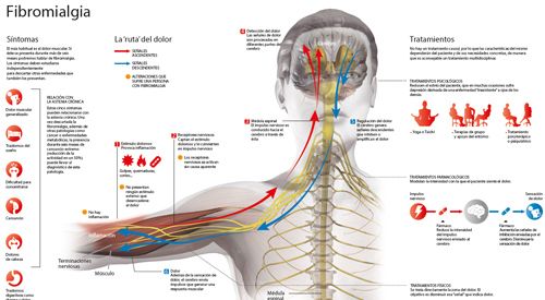 Fibromialgia: la enfermedad invisible Fibromialgia: la enfermedad invisible
