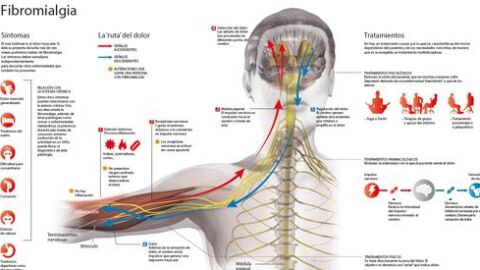 Fibromialgia