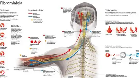 Fibromialgia Fibromialgia