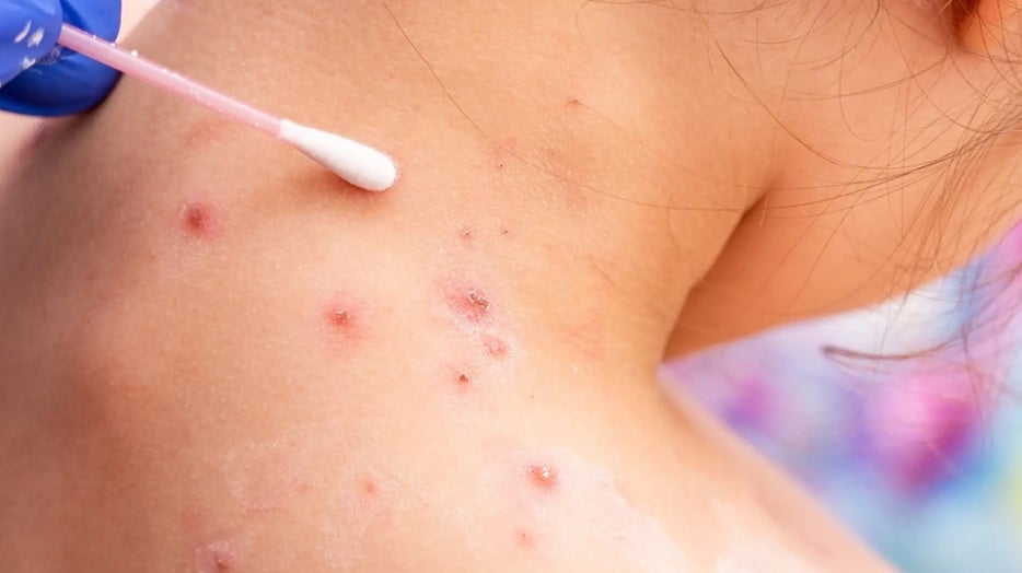 Viruela del mono: cómo saber si tengo la enfermedad y cómo distinguirla de otras similares Viruela del mono: cómo saber si tengo la enfermedad y cómo distinguirla de otras similares