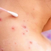 Viruela del mono: cómo saber si tengo la enfermedad y cómo distinguirla de otras enfermedades similares Viruela del mono: cómo saber si tengo la enfermedad y cómo distinguirla de otras enfermedades similares