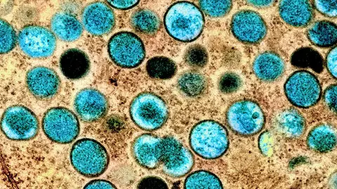 Virus de mpox visto en el microscopio viruela del mono