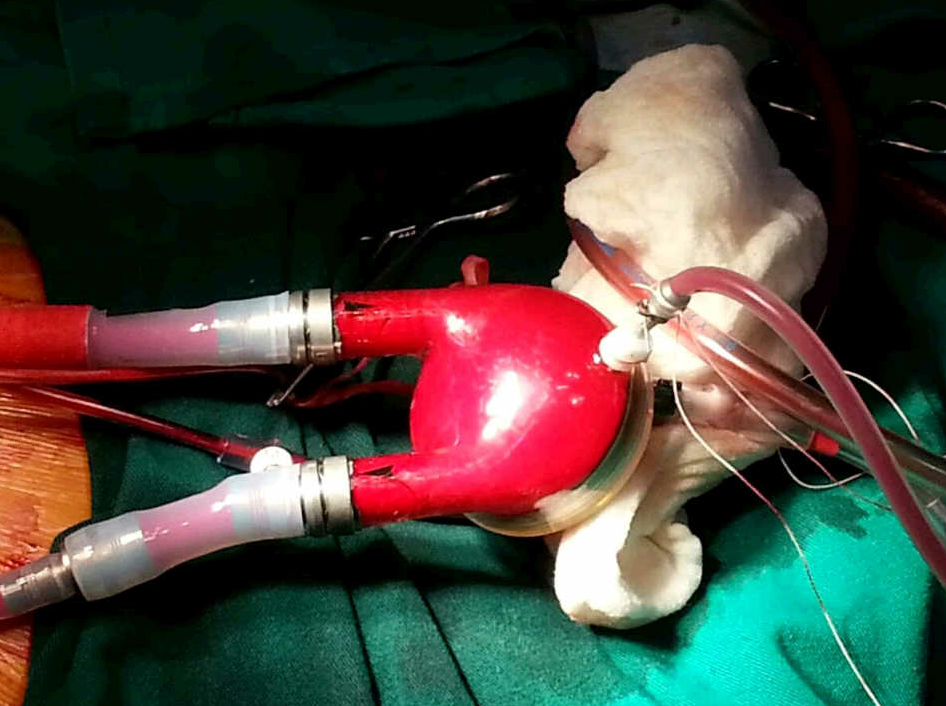 El hospital Reina Sofía implanta a un niño de tres años corazón artificial El hospital Reina Sofía implanta a un niño de tres años corazón artificial