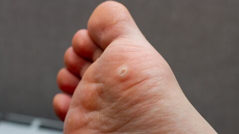 Verruga plantar