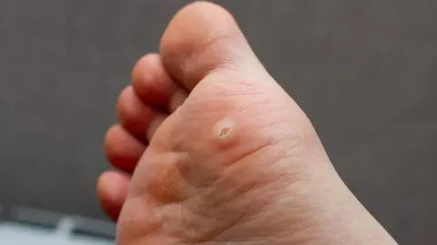 Verruga plantar Verruga plantar