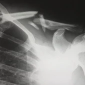 Qué es la osteoporosis: cuáles son sus síntomas, grados y a quién afecta Qué es la osteoporosis: cuáles son sus síntomas, grados y a quién afecta