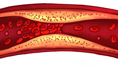 Imagen de un coágulo en la sangre