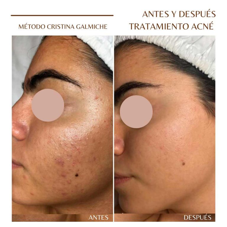 ¿Quieres poner fin a tus problemas de acné ? La experta Cristina Galmiche nos da la solución. ¿Quieres poner fin a tus problemas de acné ? La experta Cristina Galmiche nos da la solución.