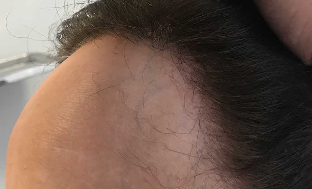 Encarnita Martínez nos habla hoy de cómo trata los casos de grave pérdida de cabello en las mujeres Encarnita Martínez nos habla hoy de cómo trata los casos de grave pérdida de cabello en las mujeres