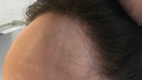 Encarnita Martínez nos habla hoy de cómo trata los casos de grave pérdida de cabello en las mujeres capilar