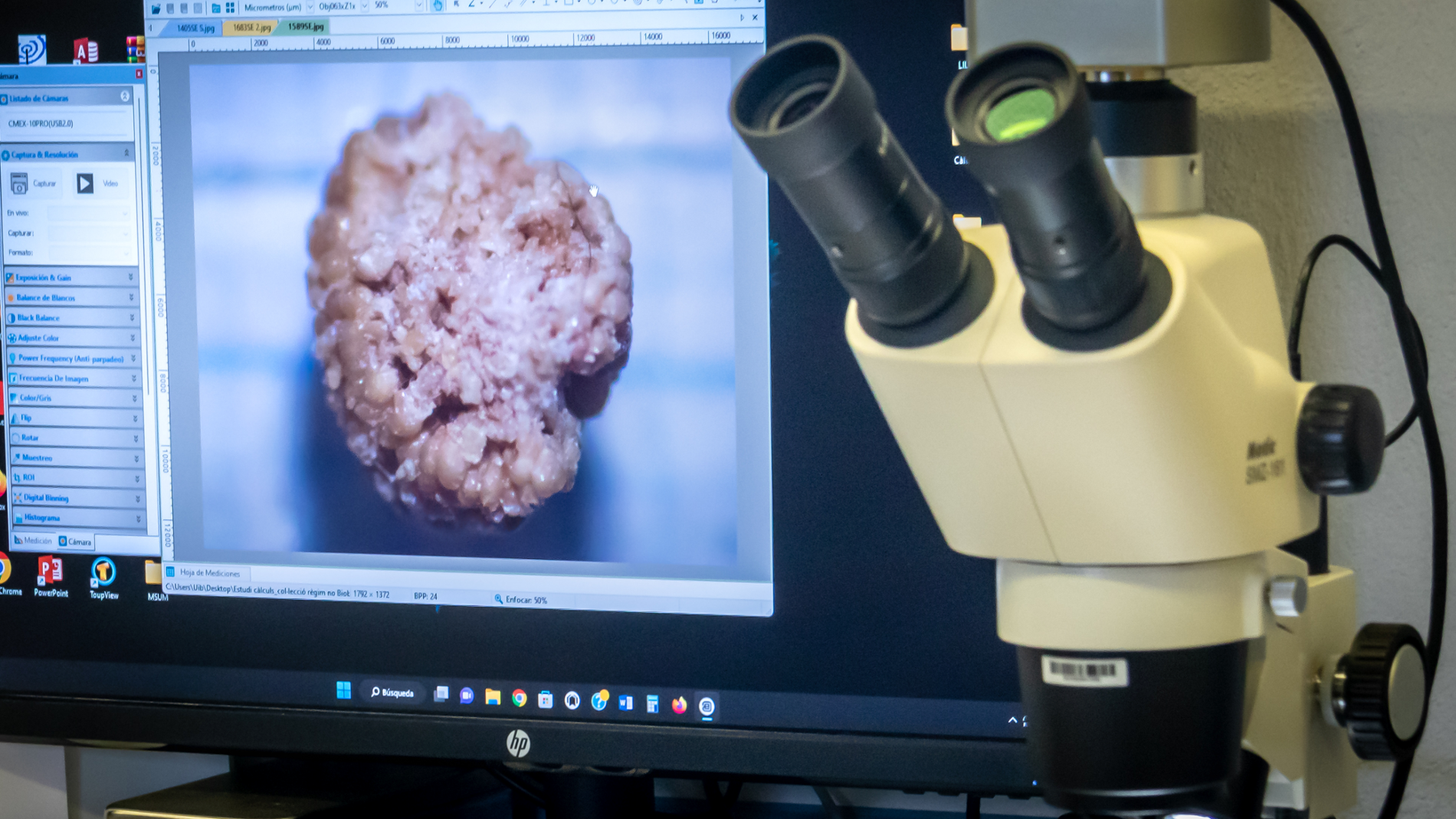 El primer biobanco de cálculos renales del mundo estará en la UIB El primer biobanco de cálculos renales del mundo estará en la UIB