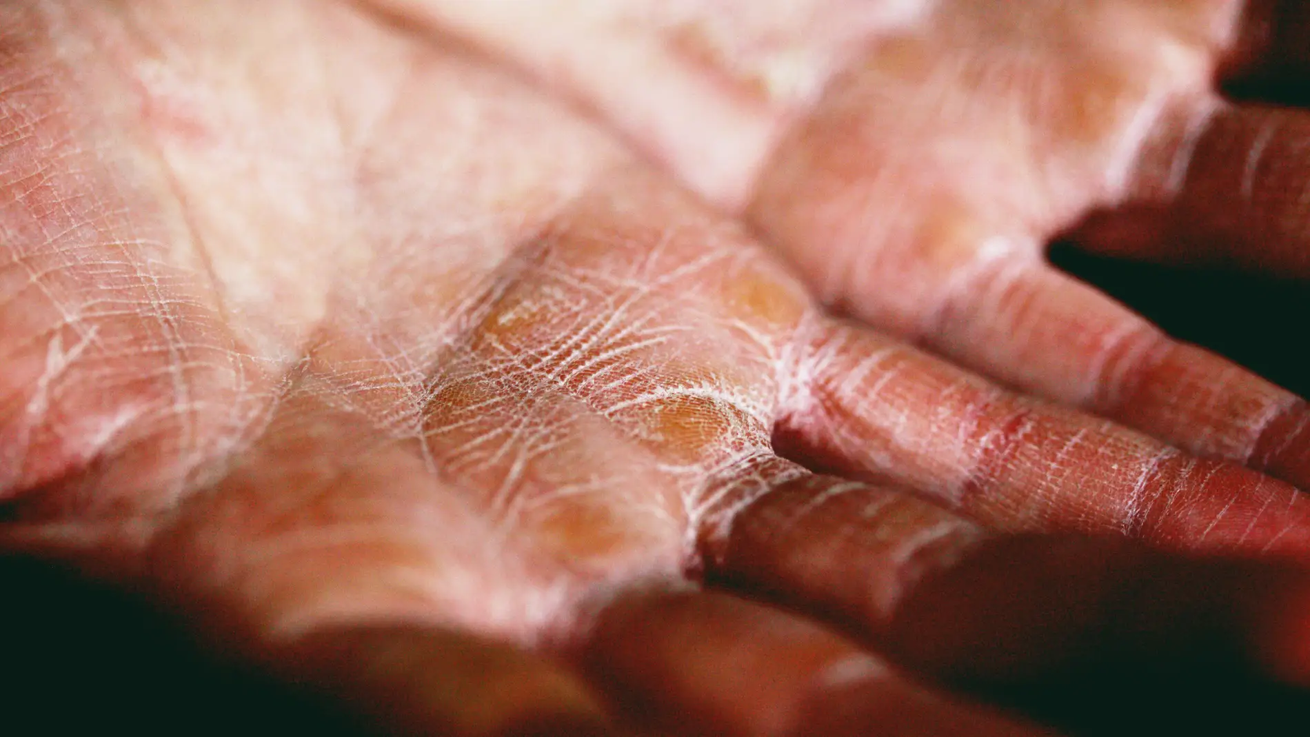 Cómo prevenir y cuidar las manos agrietadas por el frío