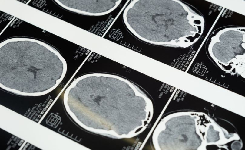 Entre el 22 y 65% de los pacientes tienen disfagia tras un ictus Entre el 22 y 65% de los pacientes tienen disfagia tras un ictus