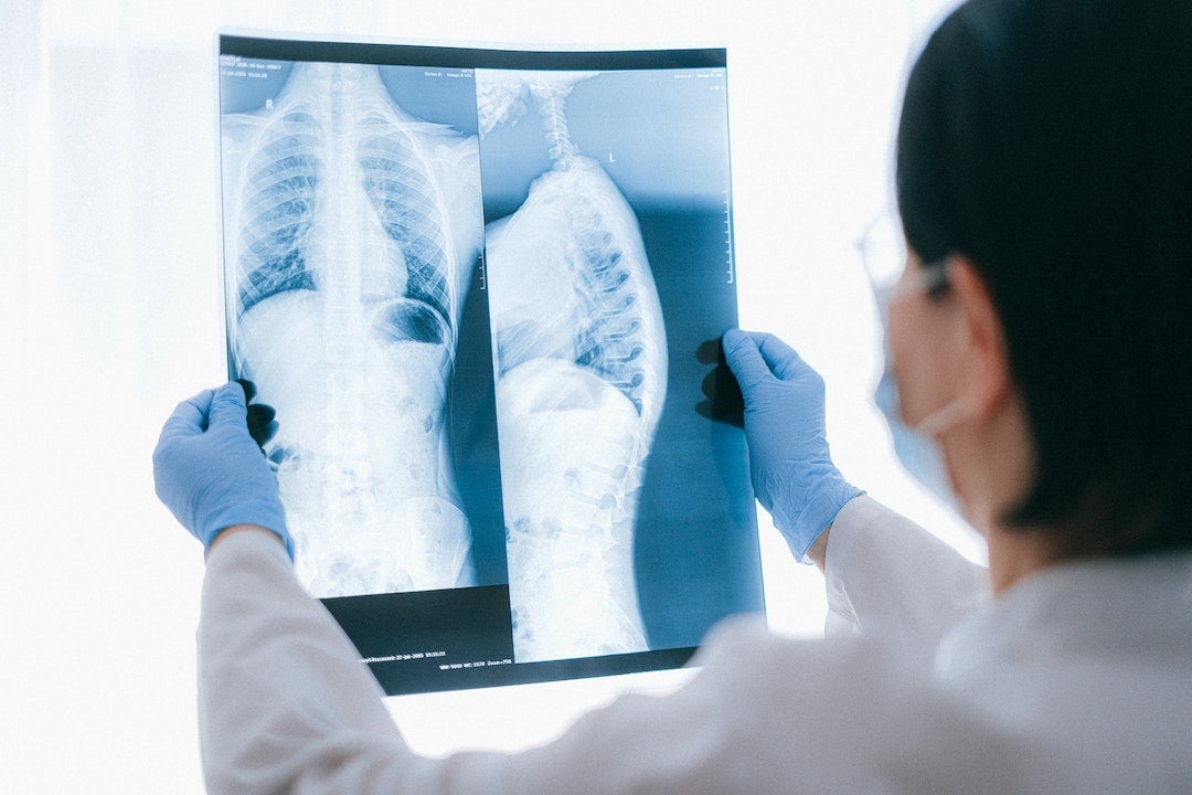 Tertulia de médicos: Videocirugía para operar tumores de pulmón Tertulia de médicos: Videocirugía para operar tumores de pulmón