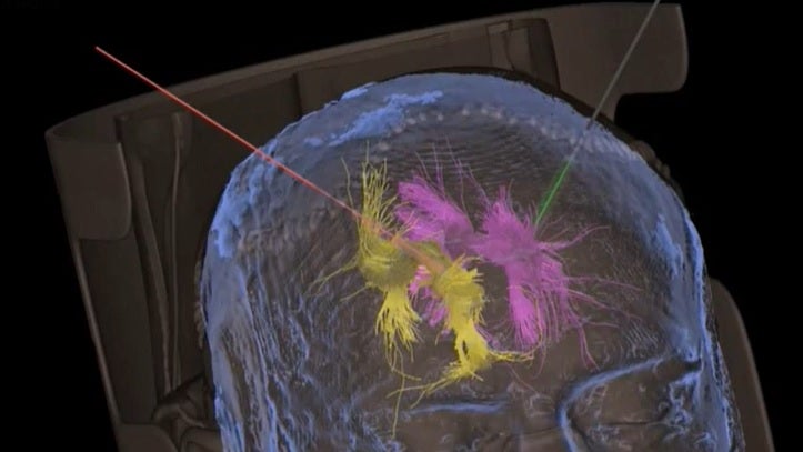 Una nueva técnica permite teñir las células malignas para detectar la metástasis cerebral Una nueva técnica permite teñir las células malignas para detectar la metástasis cerebral