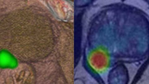 Los especialistas advierten de la caracter&iacute;stica silente de este tumor que solo da s&iacute;ntomas en estados avanzados
