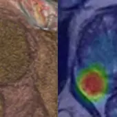 Los especialistas advierten de la característica silente de este tumor que solo da síntomas en estados avanzados Los especialistas advierten de la característica silente de este tumor que solo da síntomas en estados avanzados