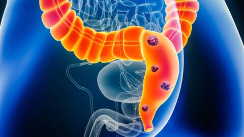 C&aacute;ncer de Colon