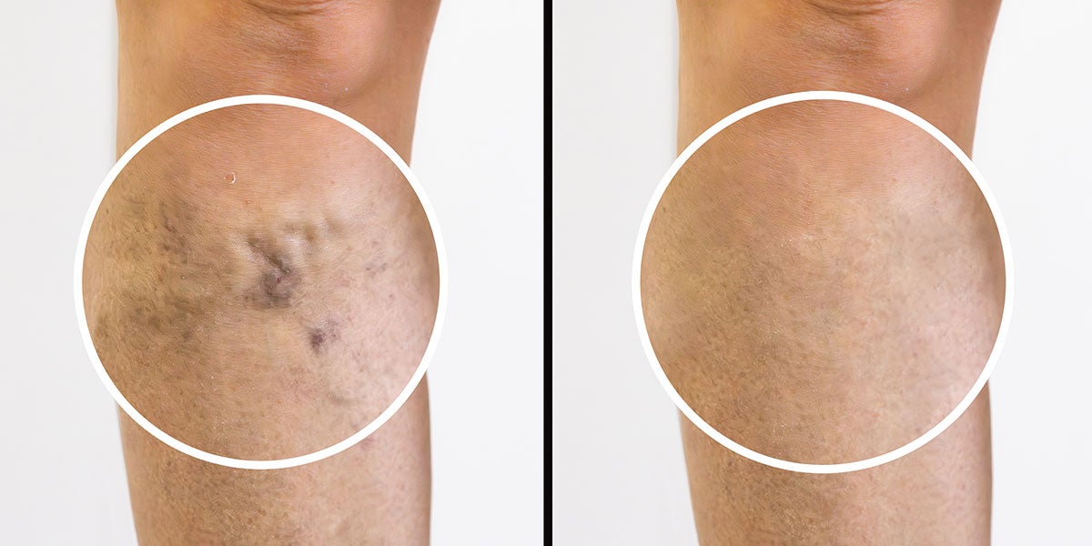 Eliminar las varices es posible gracias a la combinación de técnicas como escleroterapia con microespuma y láser Eliminar las varices es posible gracias a la combinación de técnicas como escleroterapia con microespuma y láser