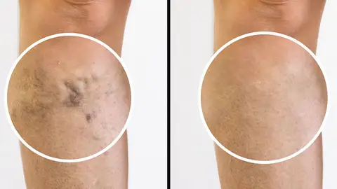 Varices Centro Dermatológico Estético