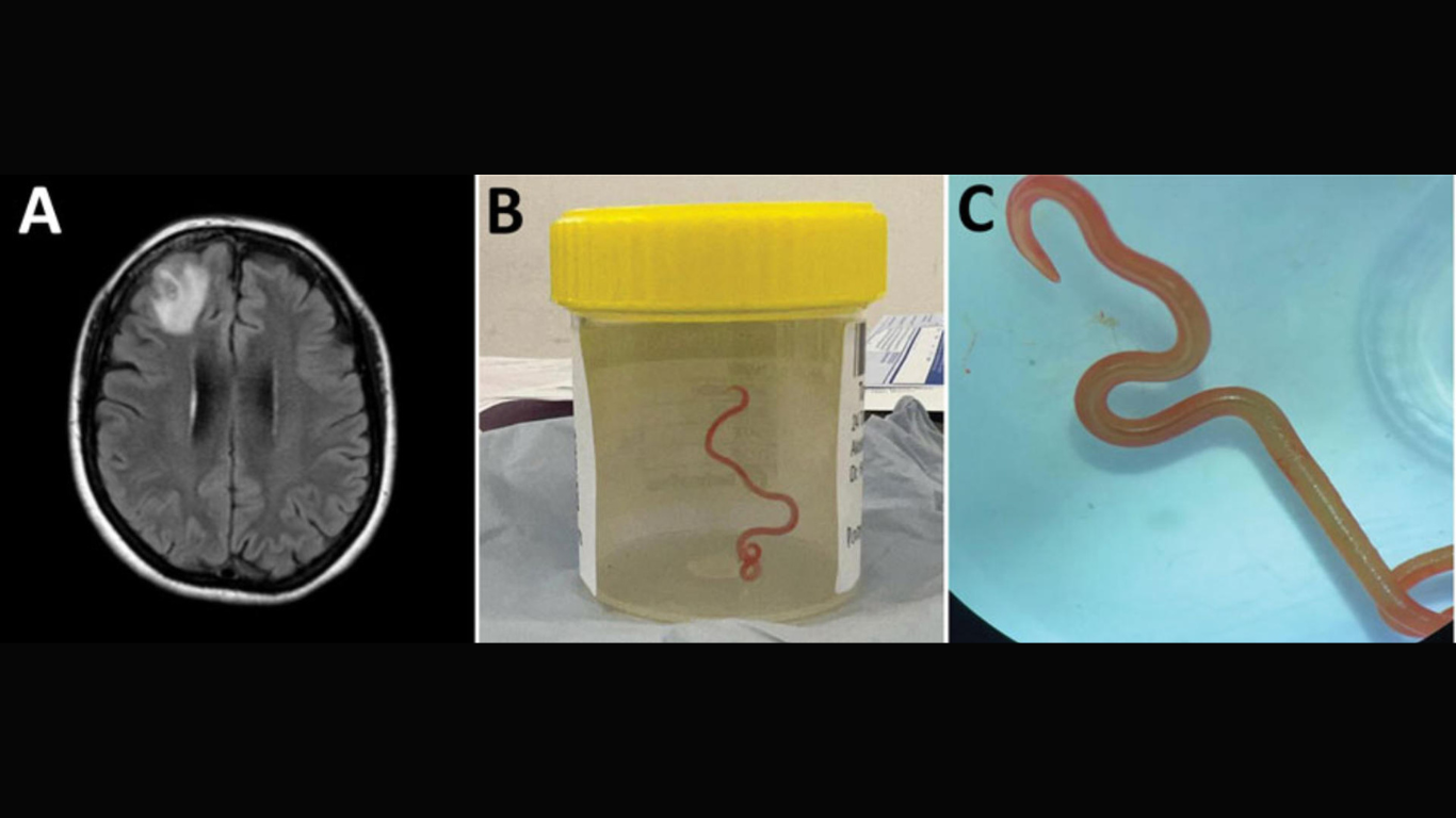 Extraen del cerebro de una mujer una lombriz intestinal viva de 8 centímetros Extraen del cerebro de una mujer una lombriz intestinal viva de 8 centímetros