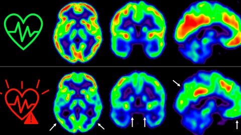 Consumo de glucosa en el cerebro de individuos seg&uacute;n su riesgo cardiovascular