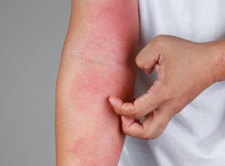 Dermatitis Atópica: qué es, de dónde viene y cómo afecta a los pacientes Dermatitis Atópica: qué es, de dónde viene y cómo afecta a los pacientes