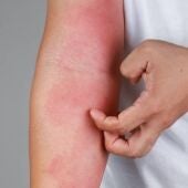 Dermatitis Atópica: qué es, de dónde viene y cómo afecta a los pacientes