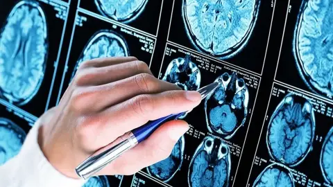 L’Alzheimer afecta moltes persones grans de Catalunya L’Alzheimer afecta moltes persones grans de Catalunya