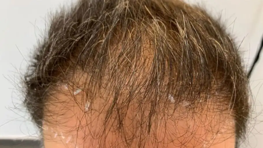 Alopecia FUE