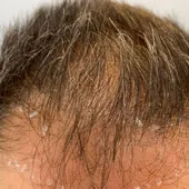 Alopecia Alopecia
