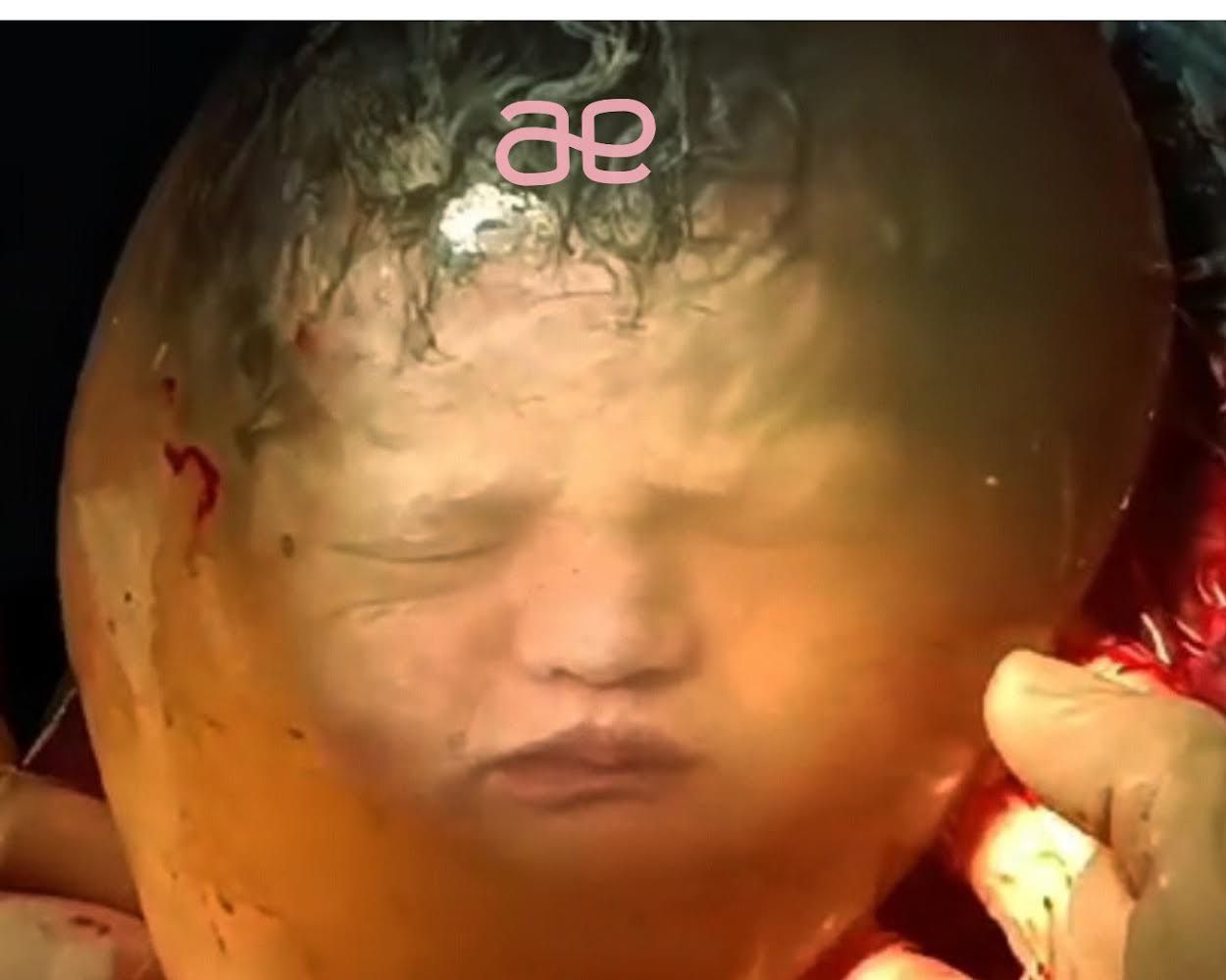 Castellón registra el primer parto velado gemelar del mundo Castellón registra el primer parto velado gemelar del mundo